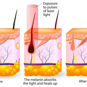 Laser hair removal. Vector diagram For Men